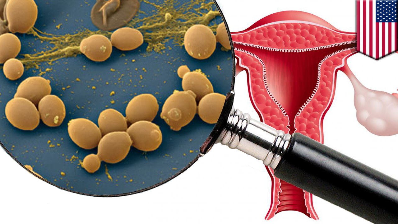 Common yeast infection botched up US doctors' first uterus transplant