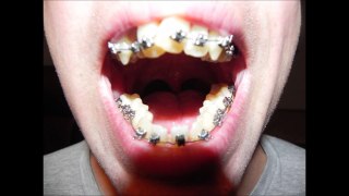 Meine Zähne Klammern Vor und Nach Bilder Progression
