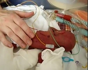 Extremfrühchen 24+6 SSW / 360g / 26,5cm - Neven bei der täglichen Pflege