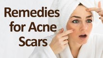 Easy Home Remedies to Get Rid of Acne Scars || Beauty Tips