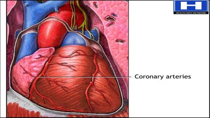 Directional Coronary Atherectomy (DCA) Procedure Animation Video