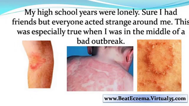 natural eczema treatment – eczema treatment natural