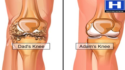 How Osteoarthritis Develops Animation - Causes & Symptoms of Osteoarthritis - Knee Pain Video