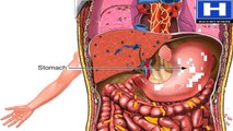 How Peptic Ulcer Disease Develops Animation - Stomach Ulcer Causes, Symptoms and Treatments Video