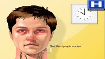 Why Do Lymph Nodes Swell Lymphatic System Animation - Anatomy and Physiology Video