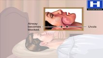 Why Snoring Occurs Animation - Where Snoring Comes From - Causes of Snoring Video