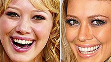Celebs With Plastc Surgery Before And After
