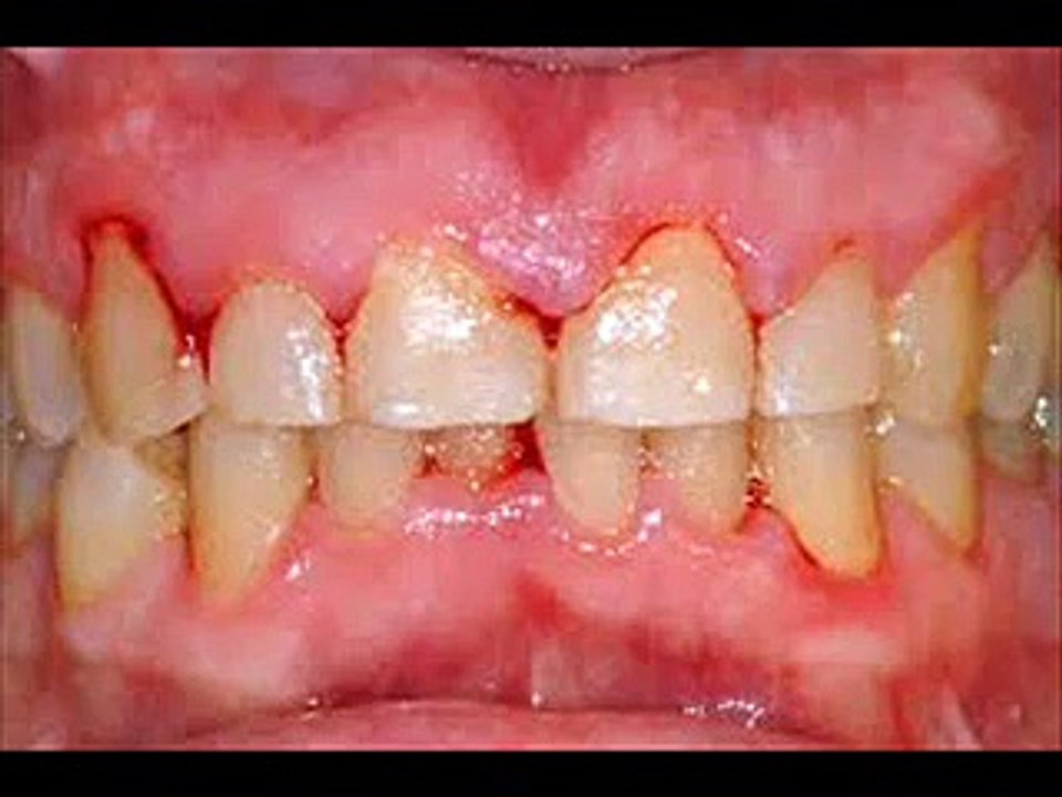 DENTAL CARE 3 | Tooth Color INFECTION CONTROL HEALTH EDUCATION ICSP 94 URDU ⁄ HINDI  URDU VIDEO