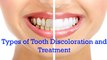 Dental Health | Dental Health & Wellness | Dental Fluorosis Or Discoloured Teeth