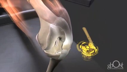 How Bone Fractures Are Repaired