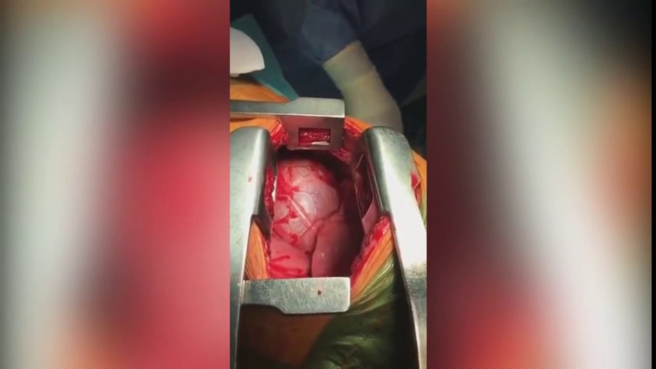 Surgeon removes sword piercing man's CHEST next to his beating heart in incredible video