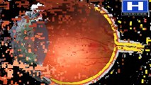 What is macular degeneration - Macular degeneration, symptoms, causes, treatment, pathophysiology and prevention