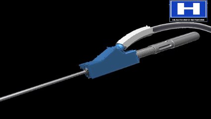 what is liposuction - How liposuction performed - Liposuction results and experience