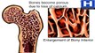 Why osteoporosis is more common in women than men - Osteoporosis symptoms, causes and treatment