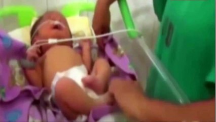 This baby was born with two noses as a result of an ultra-rare genetic condition