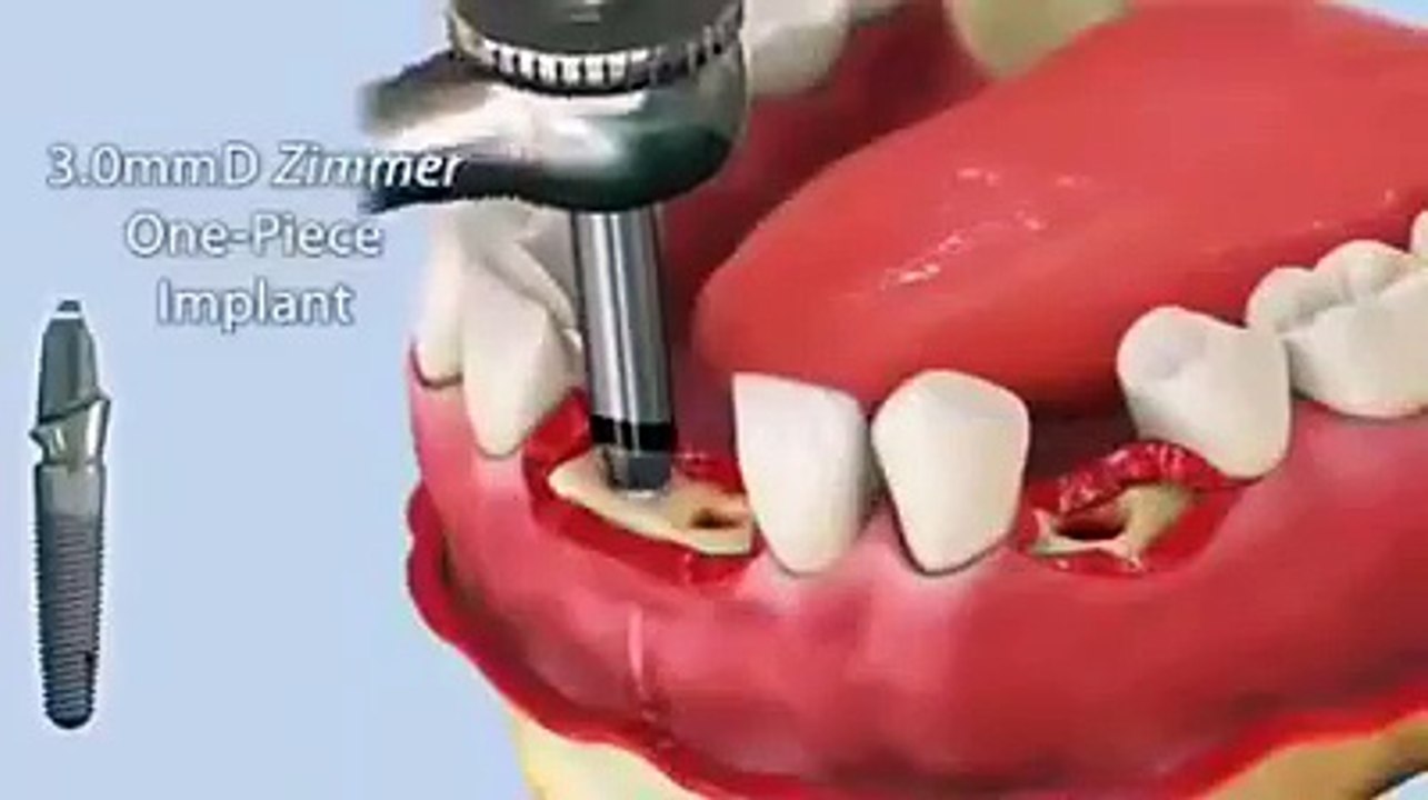 Wow Amazing Teeth transplant
