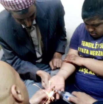 Down Sendromlu Çocuğun Parmağına Sıkışan Yüzüğü İtfaiye Çıkardı
