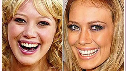Famous Celebs With Plastc Surgery Before And After