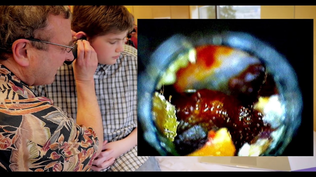 GIANT EAR WAX REMOVAL!   Dr. Paul