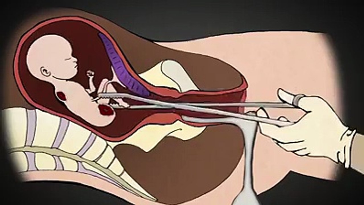 Aborto descripción gráfica