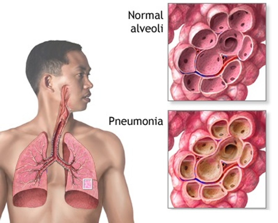 Asthma Attack Treatment, Pathophysiology and Symptoms