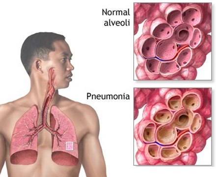 Asthma Attack Treatment, Pathophysiology and Symptoms