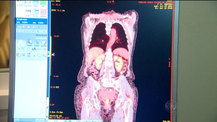 SAUDE: IMUNOTERAPIA - AVANÇO CONTRA O CANCER 20160423