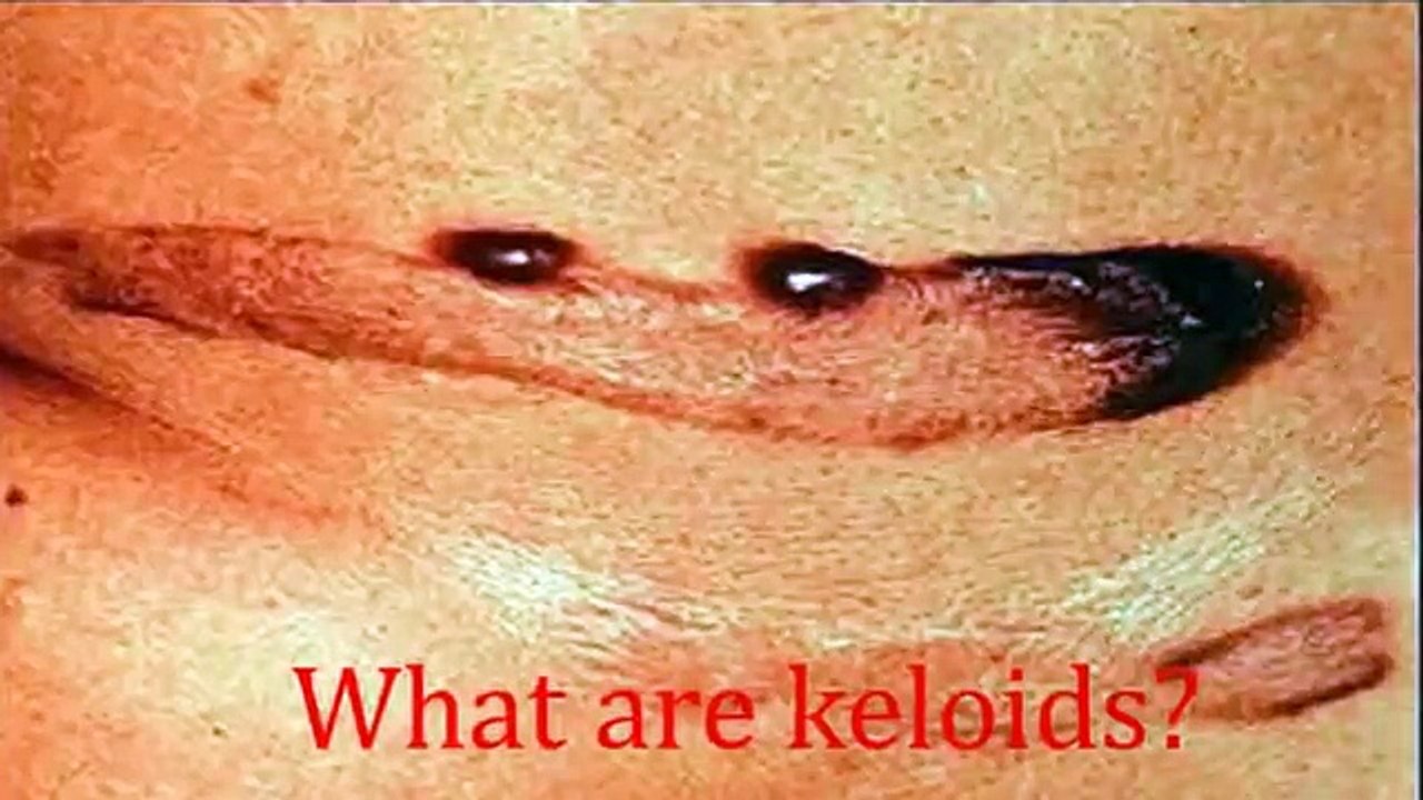 How to get rid of keloids on ear, nose, chest, face naturally at home