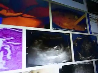 QUISTE DE NABOTH QUISTE DE CERVIX UTERINO