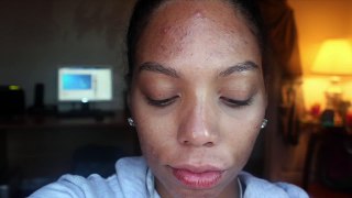 WHOAAA NO MORE ACNE 4TH MONTH UPDATE
