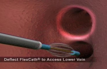 Cateterismo de precisión en el sistema cardiovascular