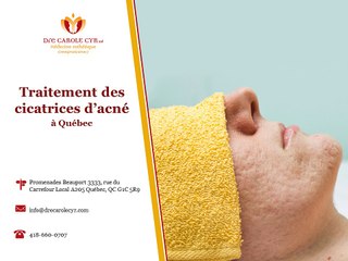 Comment traiter vos cicatrices d'acné à Québec?