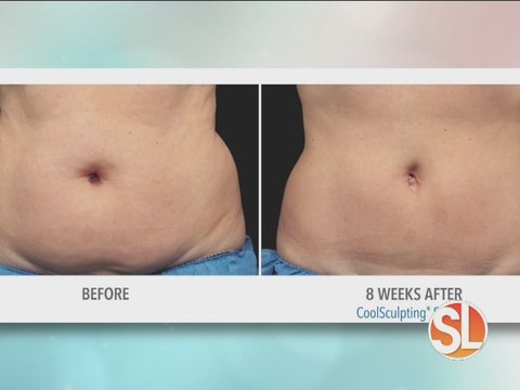 VeinMed Solutions offers Coolsculpting procedure for bikini season