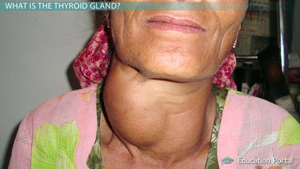 Thyroid Cancer: An Example of Malignant Neoplasia