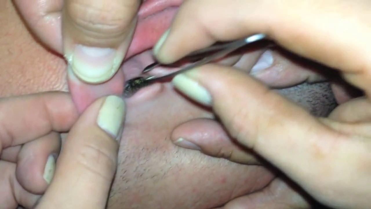 What They Pull Out Of His Ear Is The Most Disturbing Thing You’ll See This Week!