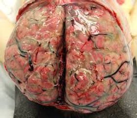 Encephalitis and Meningitis: What causes them, How your immune system plays a role, How to diagnose these conditions