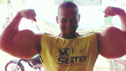 Ce bodybuildeur est devenu difforme à cause d'injections de Synthol