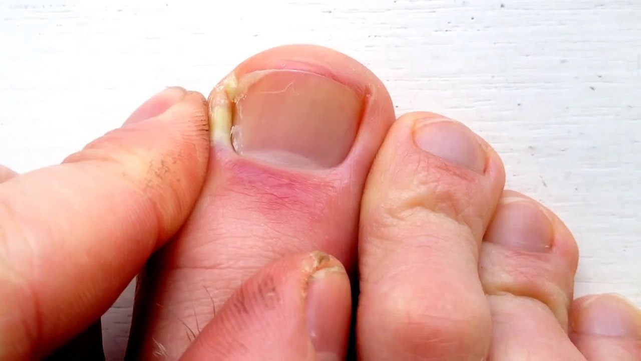Ingrown Toenail Pus video Dailymotion