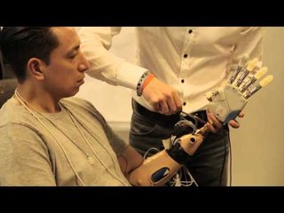 Racconto di un paziente a cui è stata impiantata una mano bionic
