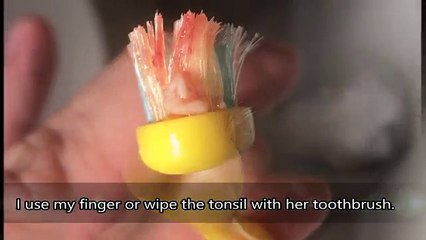 Avete mai visto delle tonsille del genere? Ecco i casi PEGGIORI ripresi da un medico...