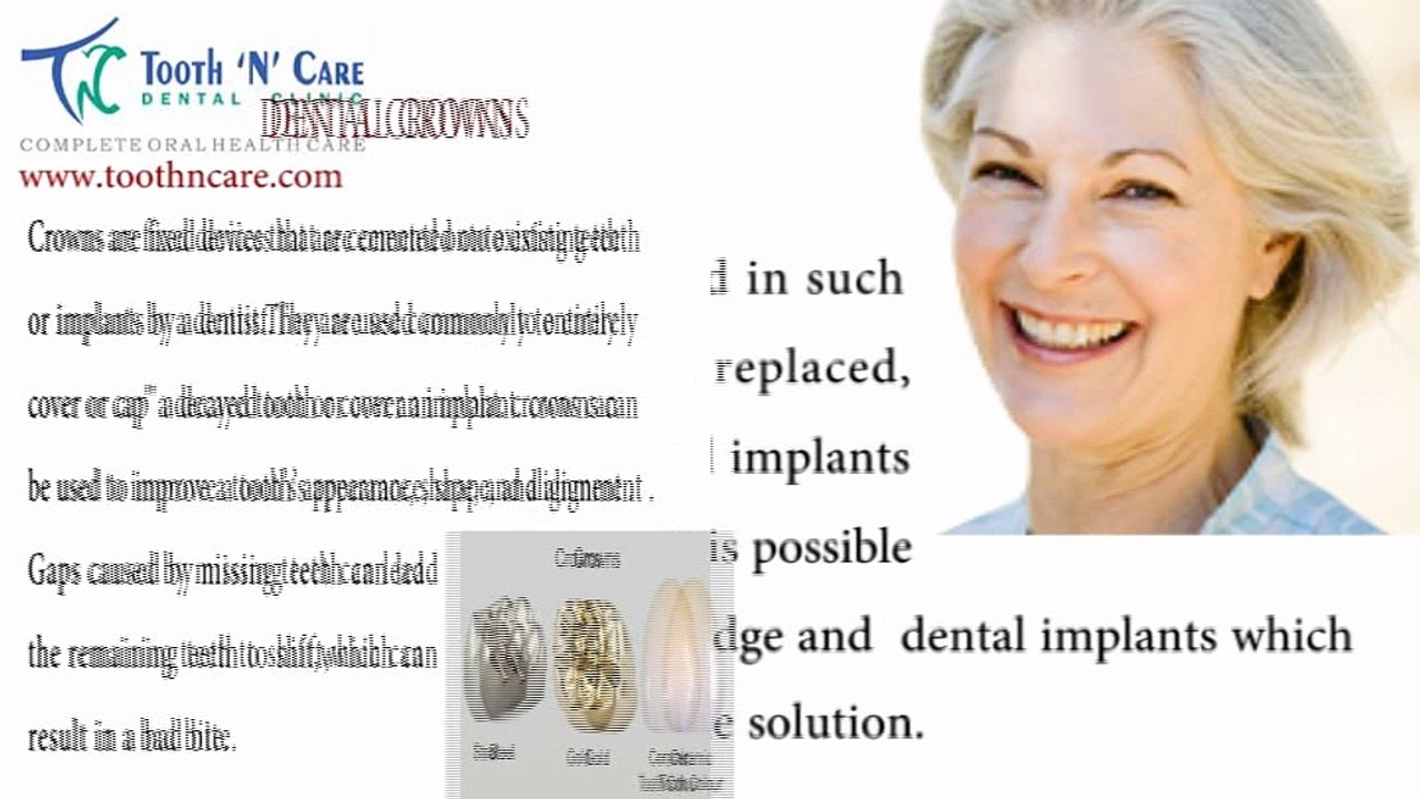 Fixed tooth replacement in chennai