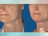 Contour Medical can take years off your face by restoring facial volume