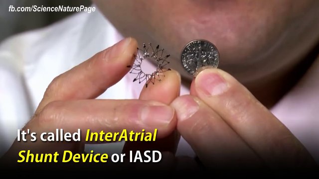 InterAtrail Shunt Device IASD could save thousands of lives from heart failure