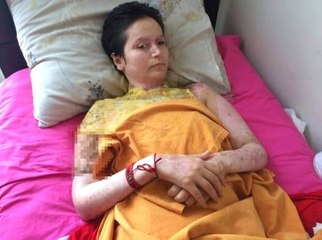 Kezzapla Yakılan Kadın, Çocuklarına Sarılmak İstiyor