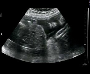 Ultrasound of Cutie Baby Girl (27 weeks)