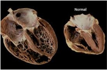 Dilated Cardiomyopathy(DCM) : Practice Essentials, Background