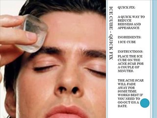 Home Remedies for Acne Scars-SD