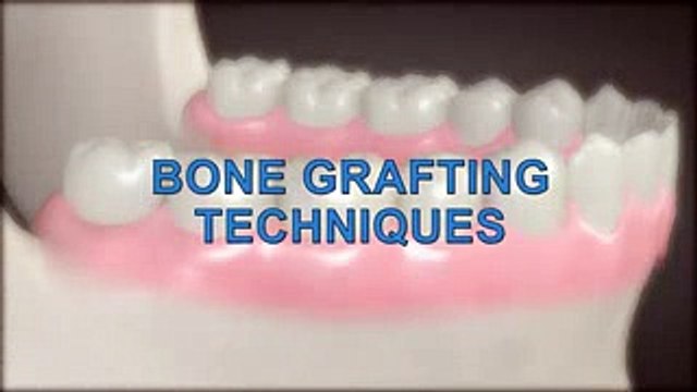 Dental Patient Education - Bone Graft For Dental Implant.