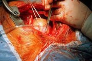 Cardiac transplant