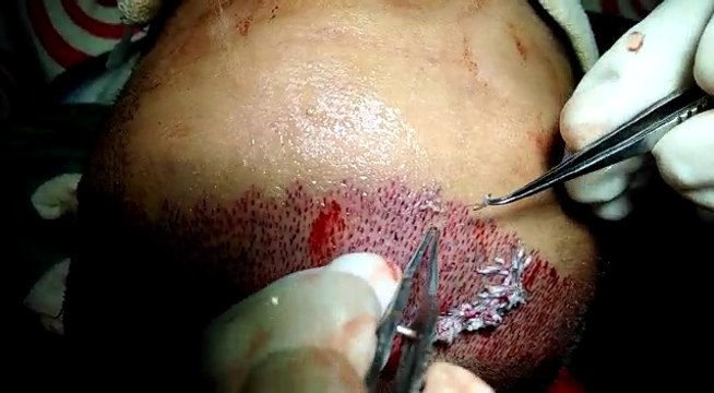 Hair Grafts Implantation during surgery at Natural Hair Transplant Clinic in Ludhiana